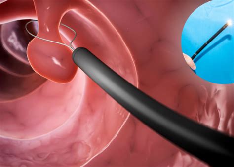 Advanced GI Endoscopy - Surat Gestro Center