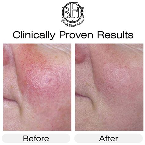 BeautyFacialExtreme Vitamin K Cream- Moisturizing Bruise Healing India ...