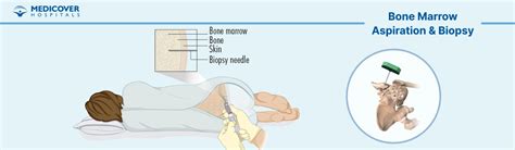Bone Marrow Aspiration and Biopsy Procedure and Recovery