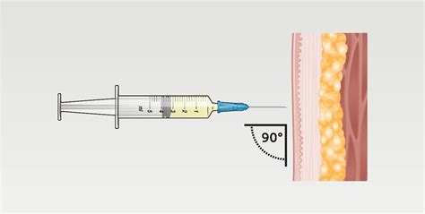 Image result for Injection Sites