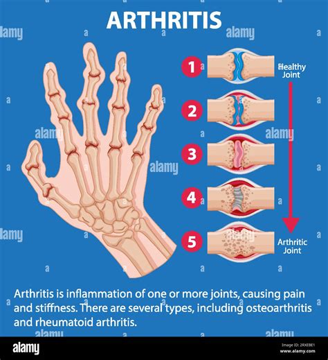 Arthritis In The Hands