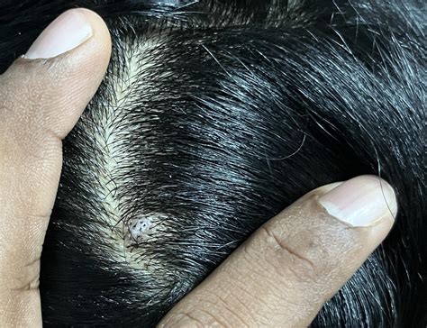 Bump on my scalp for about an year now. Can anyone tell me what this might be? Looks like pimple ...