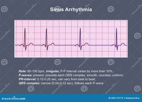 Electrocardiogram ECG Displaying Sinus Arrhythmia, 3D Illustration ...