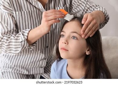 Scalp Parasites 的图像结果