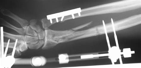 Image result for External Fixation Explained