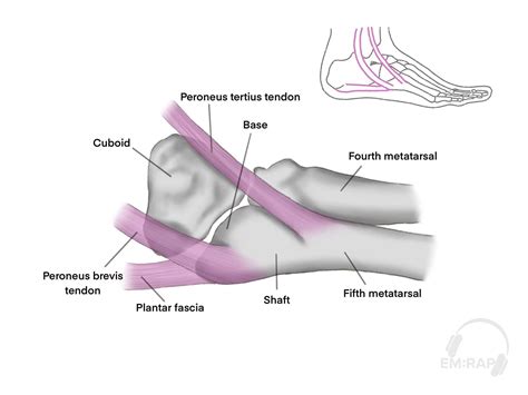 Case Report: Fifth Metatarsal Fracture - Sports Medicine Review