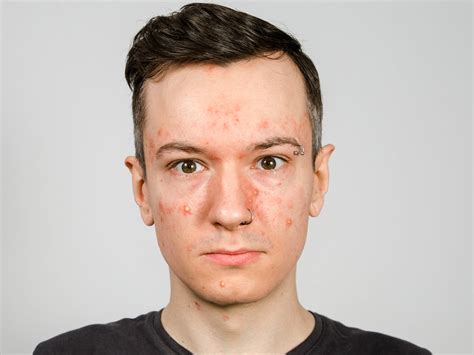 Staph Infection On Baby Face