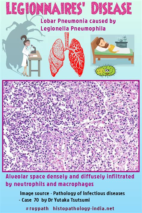 legionella pneumonia