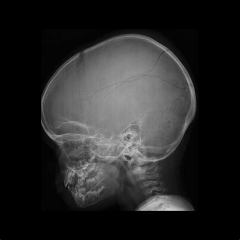 Pediatric Skull Fracture | Pediatric Radiology Reference Article ...