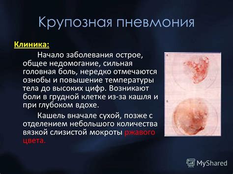 Презентация на тему: "Сестринский процесс при пневмониях.. Определение ...