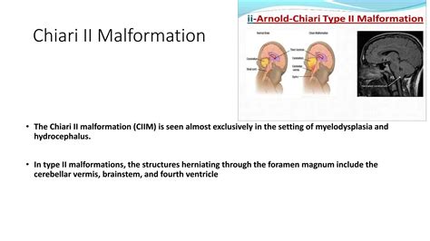 Arnold chiari malformation and types.pptx