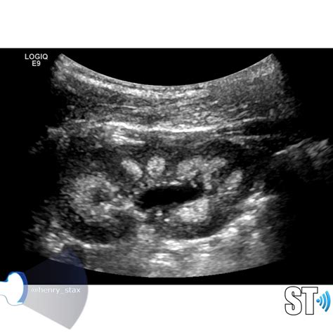 Renal Pathology – Sonographic Tendencies | Pathology, Renal, Echogenic ...