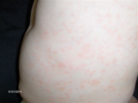 Viral Rash