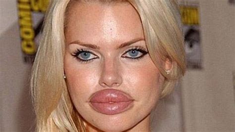 A brief history of lip augmentation | Dazed