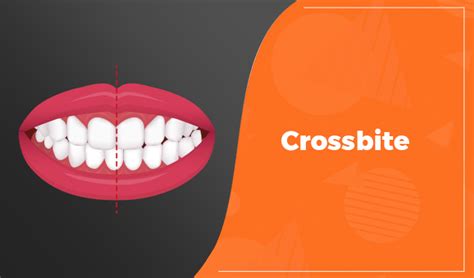 Most Common Dental Problems and Treatment by using Clear Aligners