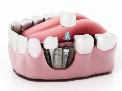 Image result for Different Types of Teeth Implants