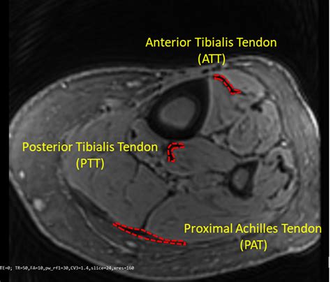 Tibialis Anterior Tendon Mri
