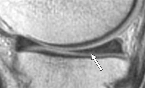 Accuracy of MRI in the Diagnosis of Meniscal Tears in Older Patients | AJR