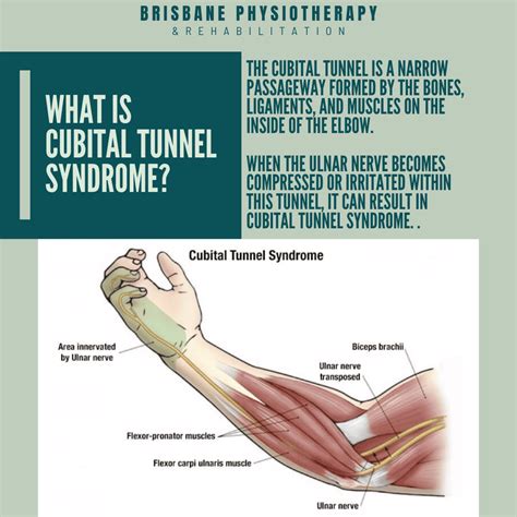 Ulnar Nerve Neck Release