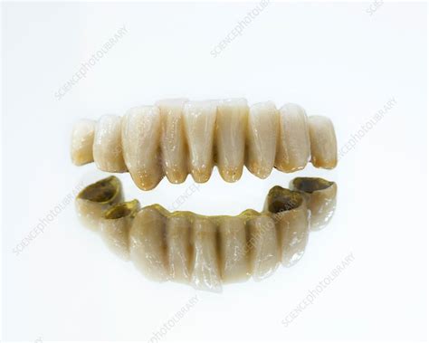 Homemade Dental Bridge 的图像结果