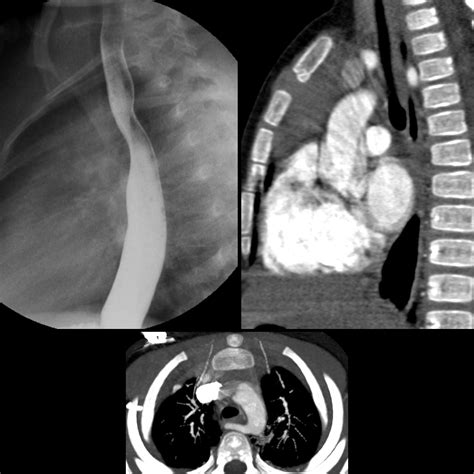 aberrant right subclavian artery | pacs