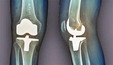 Examining Total Knee Arthroplasty Outcomes in Patients With Lupus - Rheumatology Advisor - what is arthroplasty