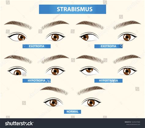 187 Human Eye Strabismus Surgery Images, Stock Photos & Vectors | Shutterstock
