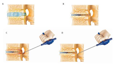 Lumbar Degenerative Disease Part 1: Anatomy and Pathophysiology of Intervertebral Discogenic ...