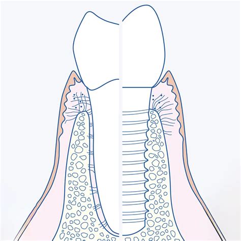 Gingivitis: Causes and treatment | CURAPROX