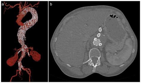 Endovascular Abdominal Aortic Aneurysm Repair: Overview of Current ...