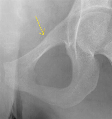 Image result for Linear Interpolation Number Line Example