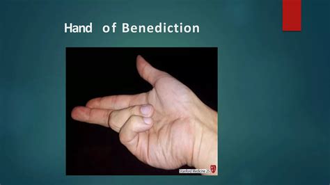 Median nerve palsy | PPTX