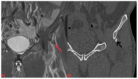Hydroxyapatite Deposition Disease: A Comprehensive Review of ...