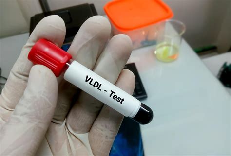 Lab Test Vldl at James Daulton blog
