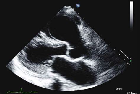 Aneurysm of the sinus of Valsalva | The British Journal of Cardiology