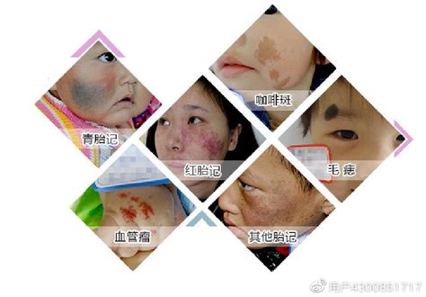 郑州市第二中医院科普：孩子胎记是什么原因导致的？_东方养生频道_东方养生