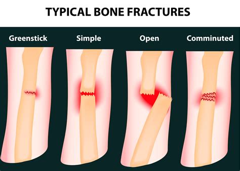 Common Fracture Classifications at Rebecca Castillo blog