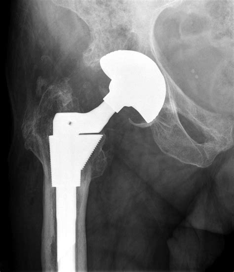 The double-mobility acetabular component in revision total hip ...