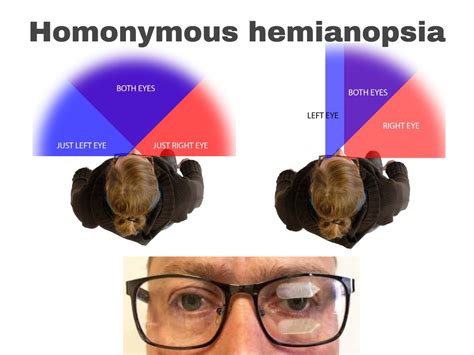Image result for Contralateral Homonymous Hemianopsia