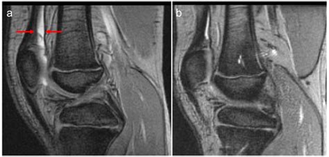 Comparison of Magnetic Resonance Imaging Scales for Assessment of ...