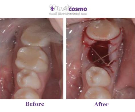 Image result for Getting Tooth Removed