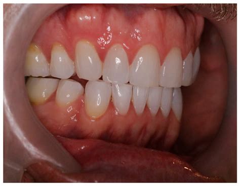 Immediate Cervical Muscle Response to Optimal Occlusal Positioning: A ...