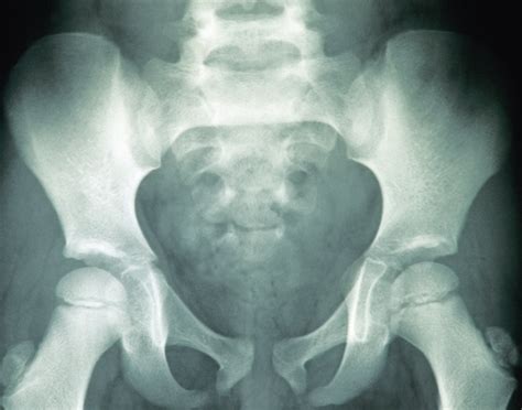 Hip X Ray Anatomy