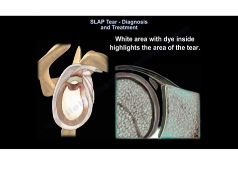 SLAP Tear Diagnosis and Treatment — OrthopaedicPrinciples.com