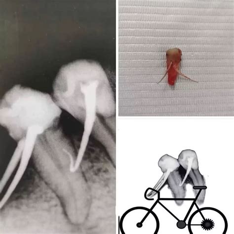 DentalRadar | 🇺🇸Filiform wart on the lip Filiform warts look different ...