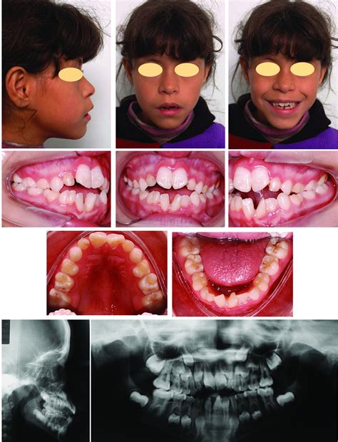 People With Triple X Syndrome
