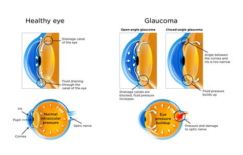 Glaucoma | My Doctor Online