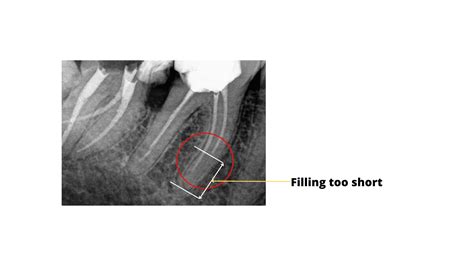 The telltale signs of failed root canal with X-ray pictures