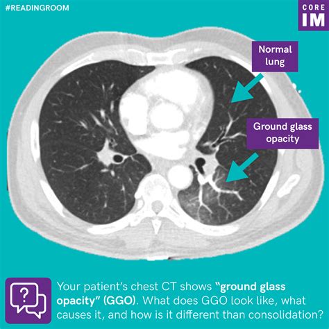 Ground Glass In Lungs
