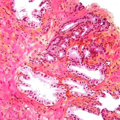Prostate Cancer 的图像结果